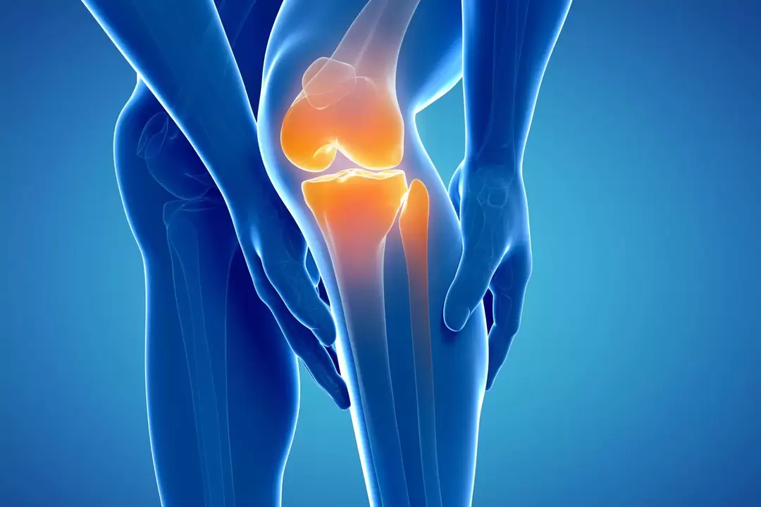 Arthrosis of the knee joint (gonarthrosis, deformed osteoarthritis)