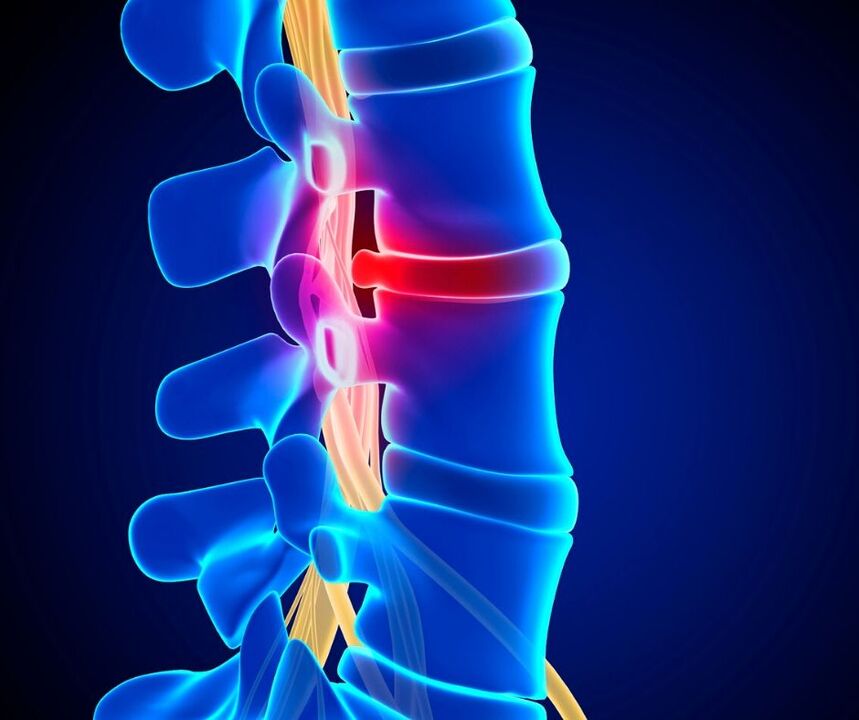 Intervertebral disc damage during osteochondrosis