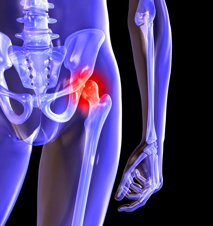 The arthrosis of the thigh joint
