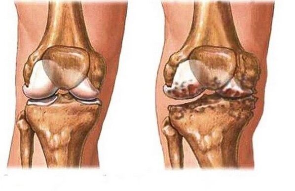 Healthy and sensitive joint