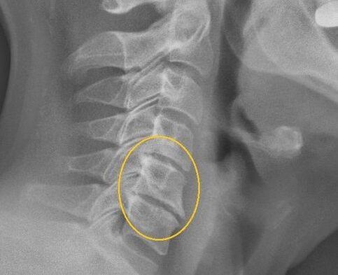 Cervical spine osteochondrosis on x -ray