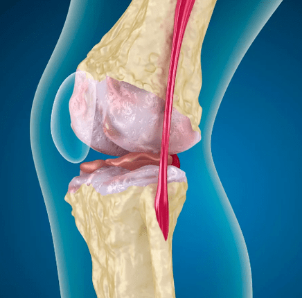 Arthrosis of the knee joint