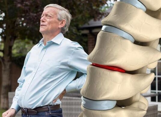 Osteochondrosis affects the intervertebral discs and causes back pain